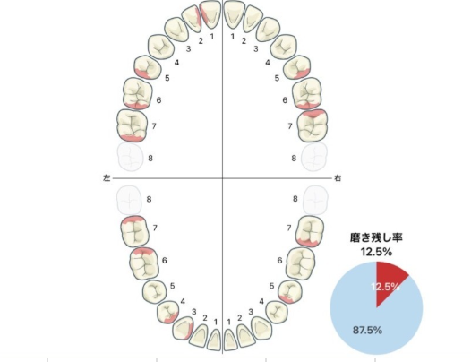 ブラッシング指導後の磨き残し（赤い部分が大きく減った）