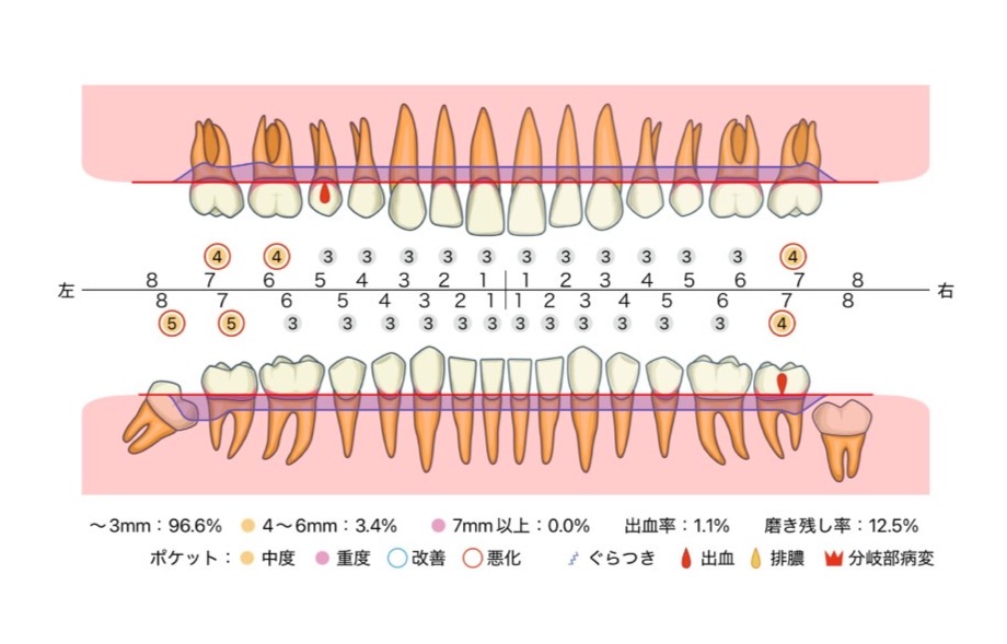 歯周病検査チャート