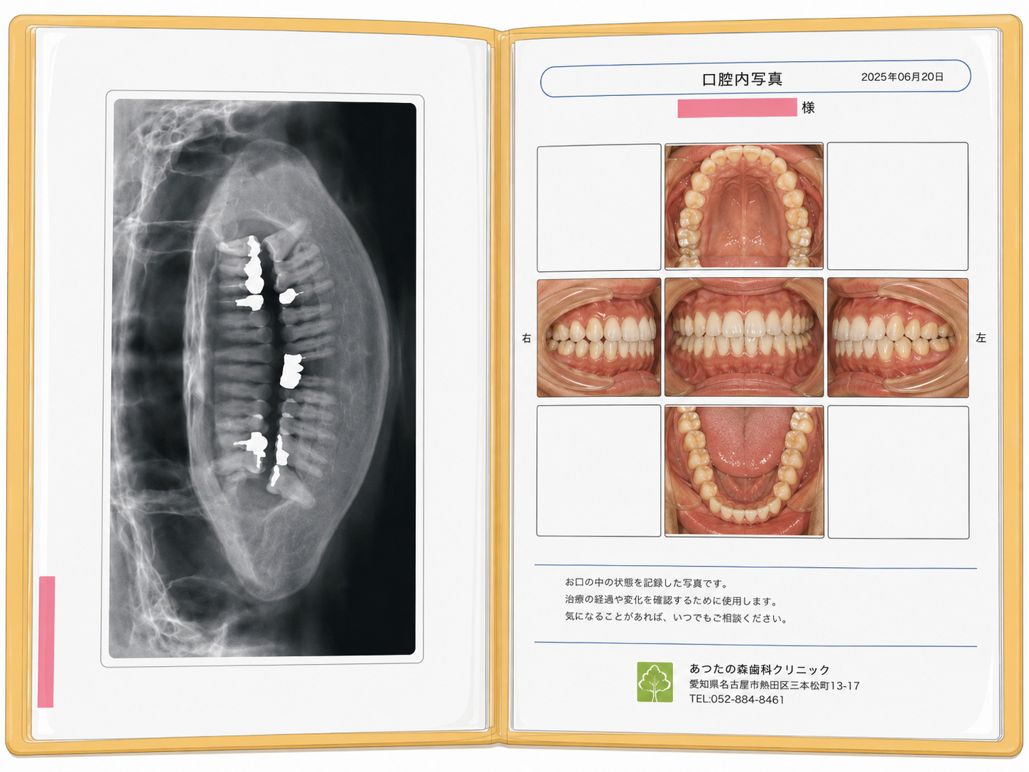 健康手帳に保管されたレントゲンと口腔内写真